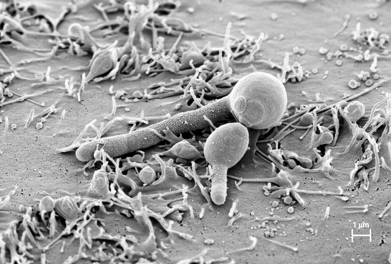 ADHS Kinder, Candida Kinder, ADHS durch Candida, Candida verursacht ADHS, ADHS & Candida, Darmsanierung bei ADHS,